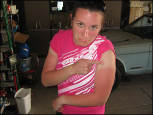 image:Kim's awesome-o sunburn
