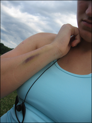 image:Kim's bruised wrist