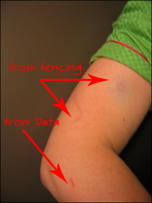 image:Kim's bicep fencing wound