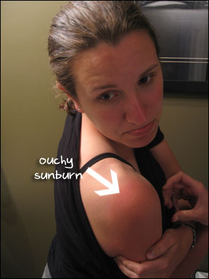 image:Ouchy Sunburn