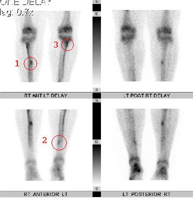 Three stress fractures