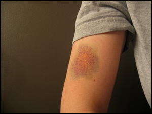 image:My nasty fencing bruise