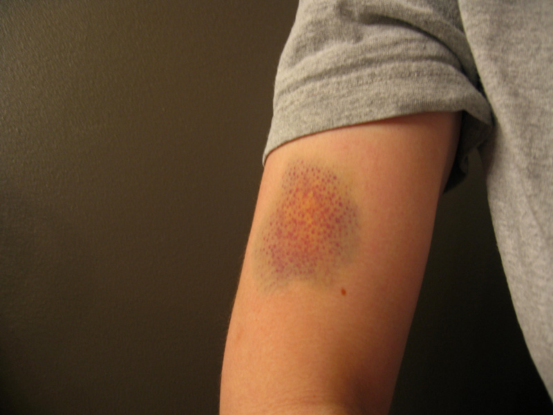 Ilaxstudio Bruise